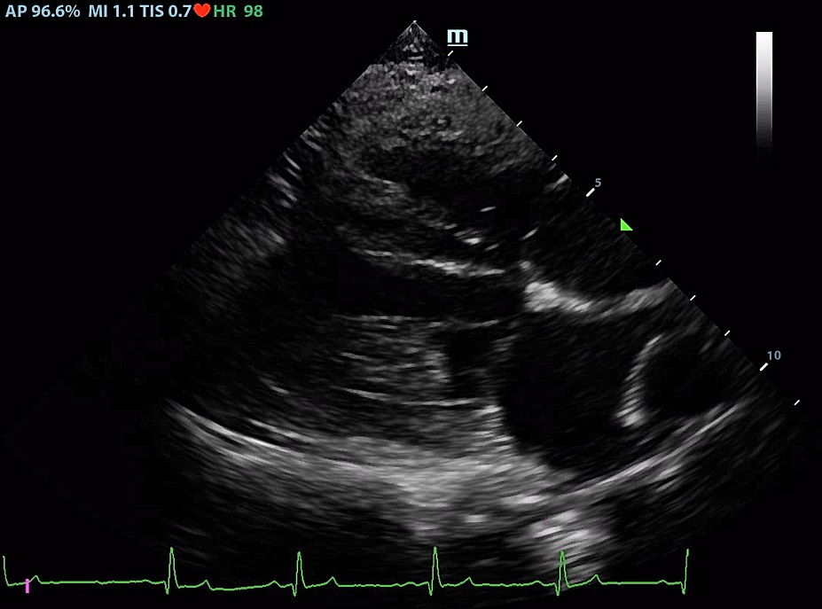 Imagen bidemensional, donde se puede observar la dilatación de la arteria pulmonar respecto a la vena pulmonar.