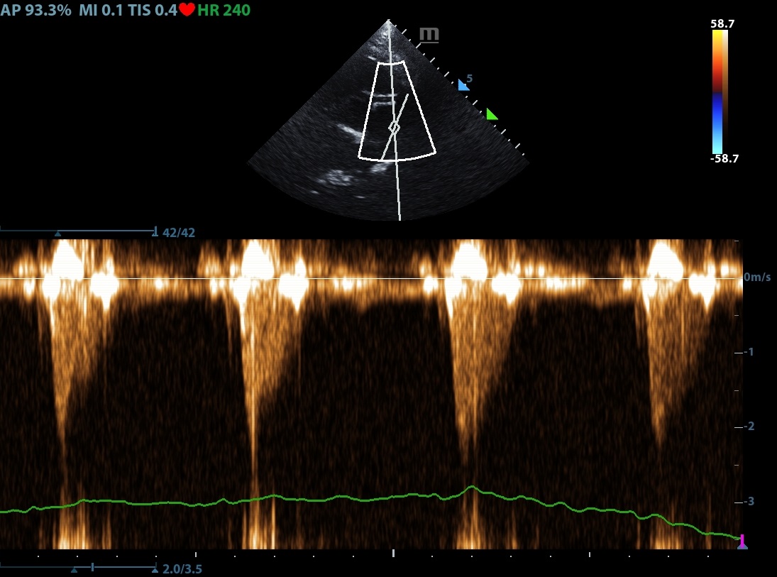 Imagen flujo de la arteria pulmonar, viendo un cambio en la morfología de la silueta Doppler asemejándose a un flujo aórtico.